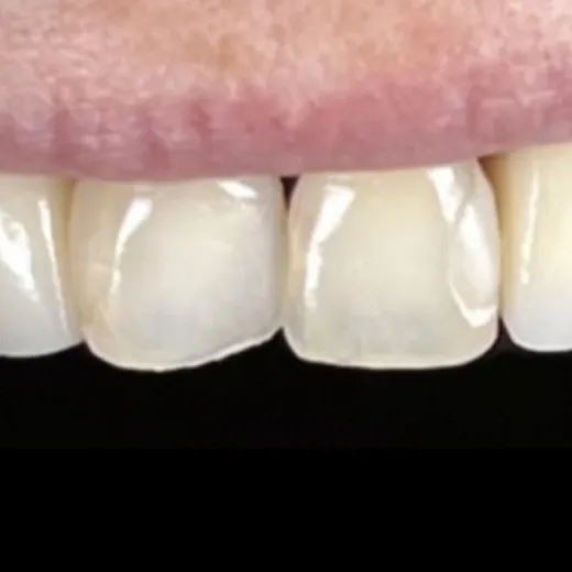 Antes: dentes superiores da frente com bordas irregulares e cores diferentes