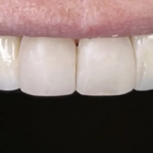 Depois: dentes superiores da frente com formato e cor uniformes