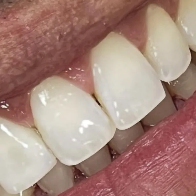 Antes: dentes superiores da frente, vistos de lado no sorriso