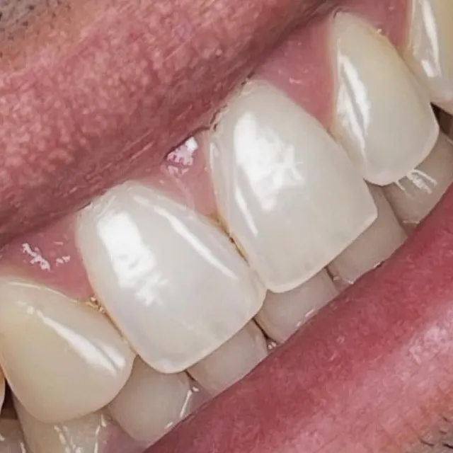 Depois: os mesmos dentes depois do tratamento, vistos de lado no sorriso