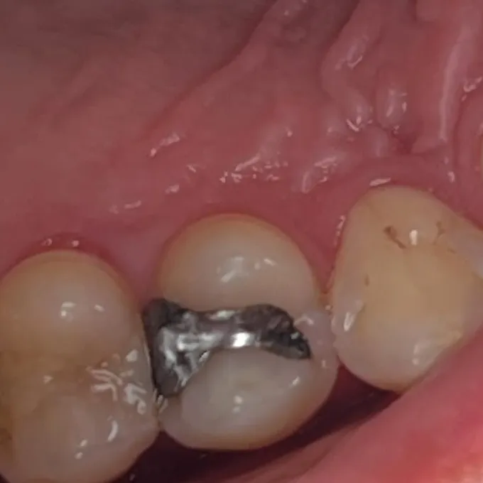 Antes: dente do fundo com restauração antiga de amálgama, vista de cima