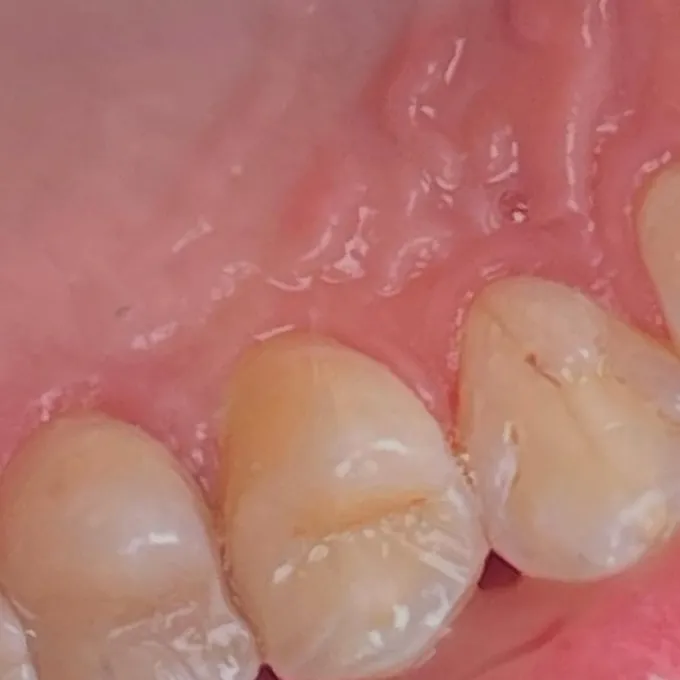 Depois: o mesmo dente restaurado na cor do dente, vista de cima