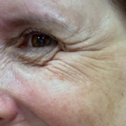 Antes: linhas de expressão ao redor dos olhos