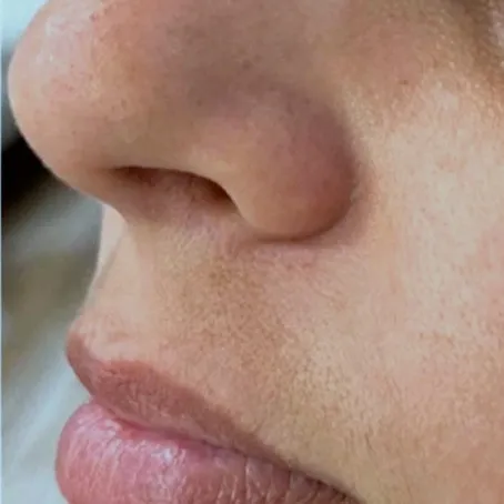 Antes: lábios de perfil, antes do preenchimento