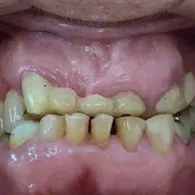 Antes: dentes superiores desgastados e escurecidos