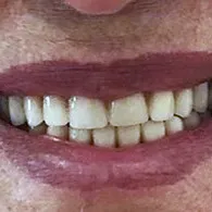 Depois: dentes repostos, com formato e cor uniformes