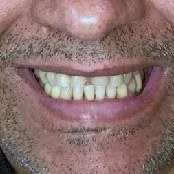 Antes: dentes inferiores irregulares e desalinhados