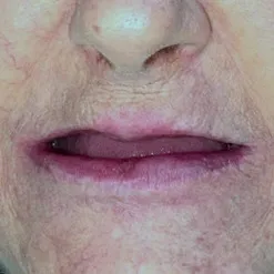 Antes: boca com dentes ausentes
