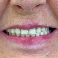 Depois: sorriso completo