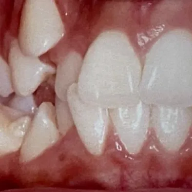 Antes: dentes encavalados e desalinhados