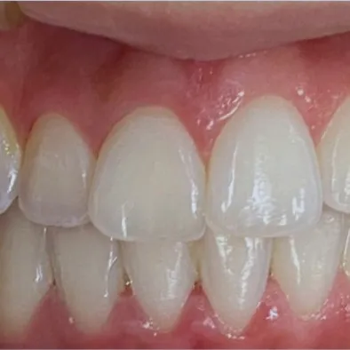 Depois: dentes alinhados