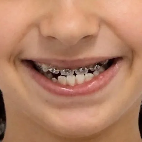 Antes: sorriso com aparelho fixo, do nariz ao queixo
