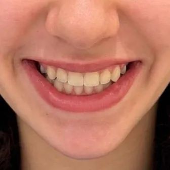 Depois: o mesmo sorriso sem aparelho, com os dentes alinhados